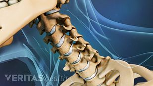 Como quitar dolor de cervicales y nuca